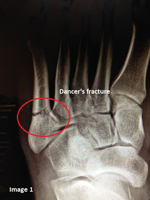 5th Metatarsal Fractures – Conservative vs. Surgical Care